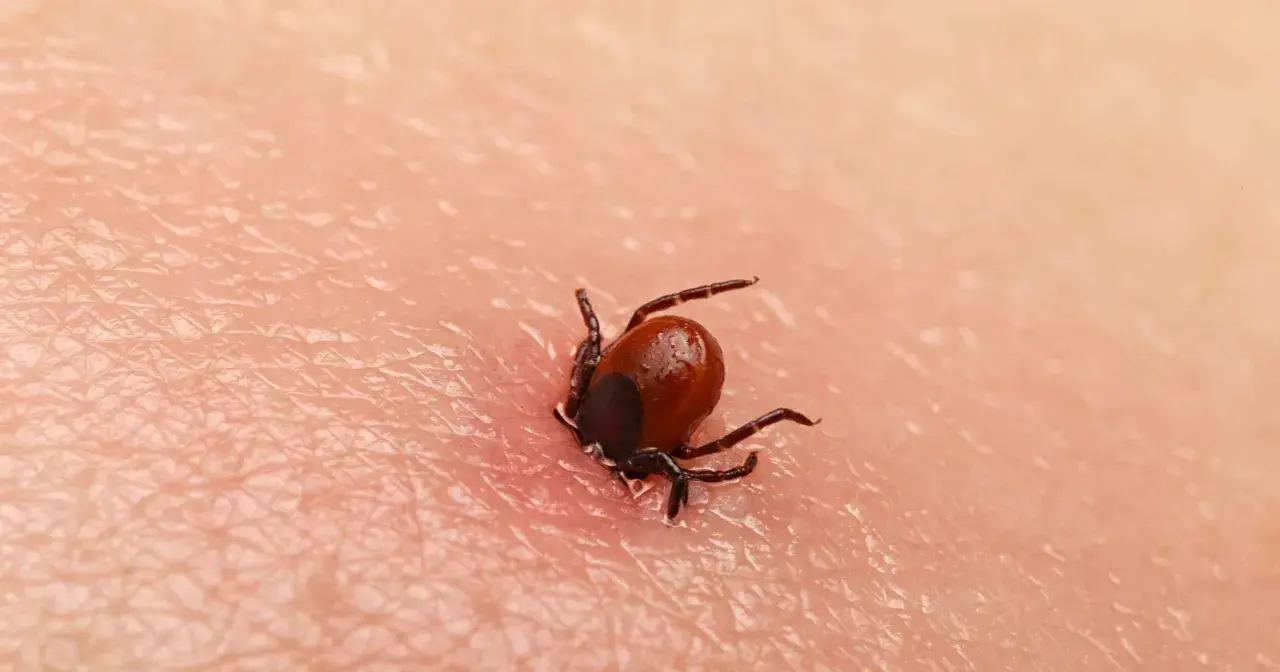Zbliżenie na wbitego kleszcza na ludzkiej skórze. Pajęczak z ośmioma odnóżami wgryza się w naskórek, widoczny jest zaczerwieniony obszar wokół niego.