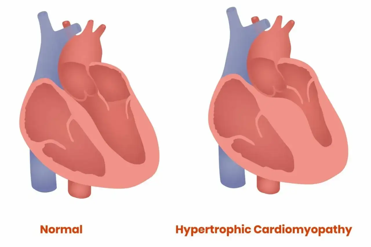 Porównanie serca kota z HCM i zdrowego. Mięsień sercowy w HCM jest pogrubiony, utrudniając pracę serca.