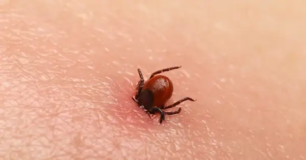 Zbliżenie na wbitego kleszcza na ludzkiej skórze. Pajęczak z ośmioma odnóżami wgryza się w naskórek, widoczny jest zaczerwieniony obszar wokół niego.